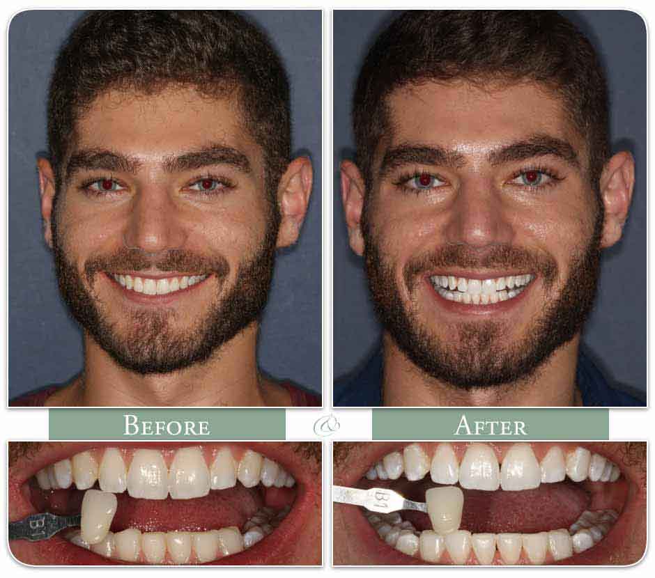 Teeth Whitening Wilmington, DE - Tooth Bleaching Dentist