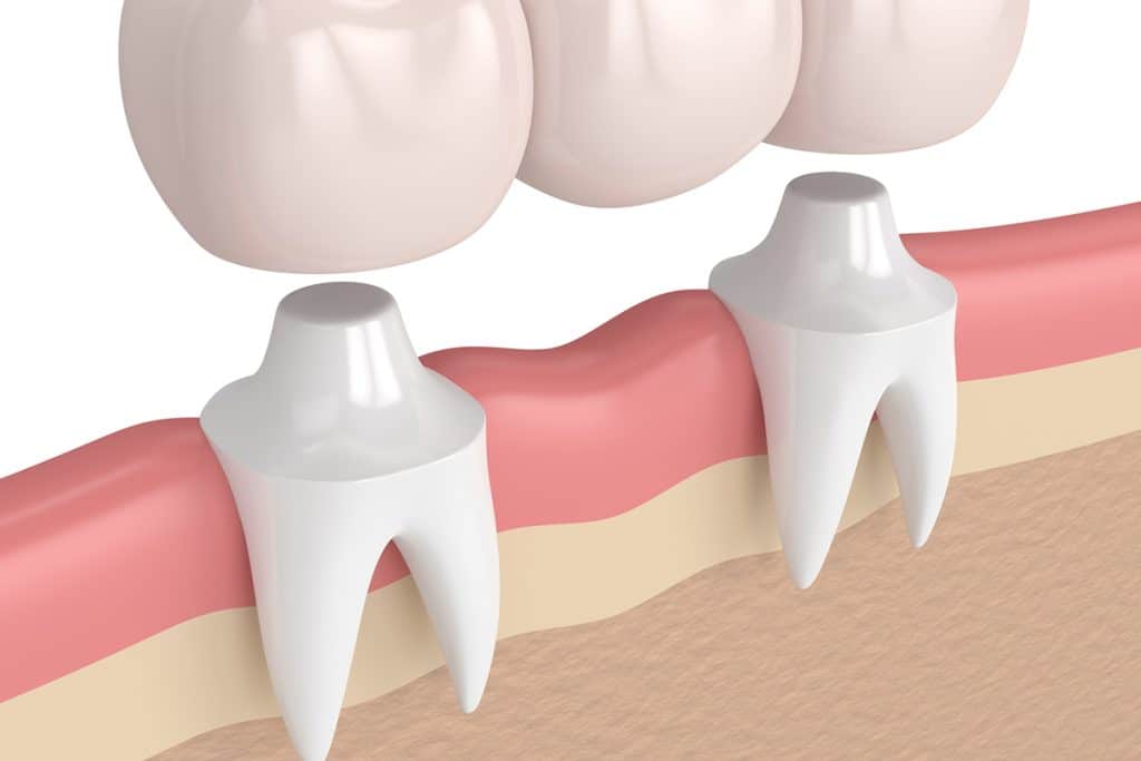 can-a-dental-bridge-be-removed-and-recemented-glassman-dental