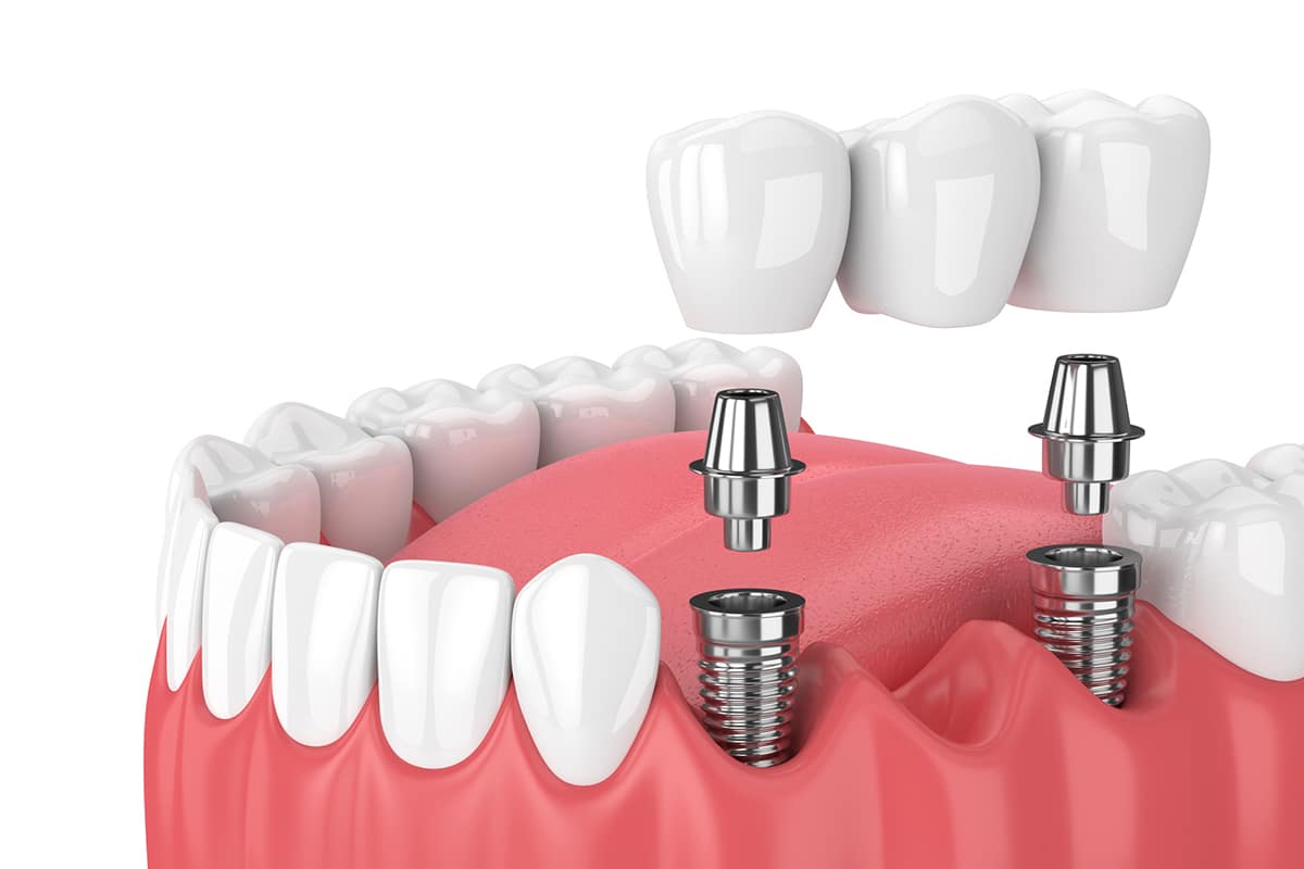 How Long Does It Take For A Dental Bridge To Settle 