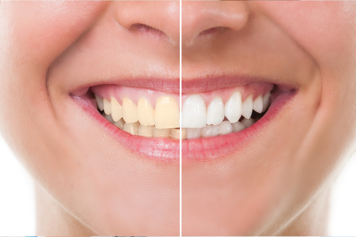 how-long-does-teeth-whitening-last